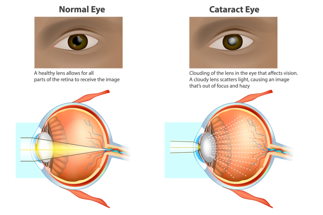 Cataract iStock