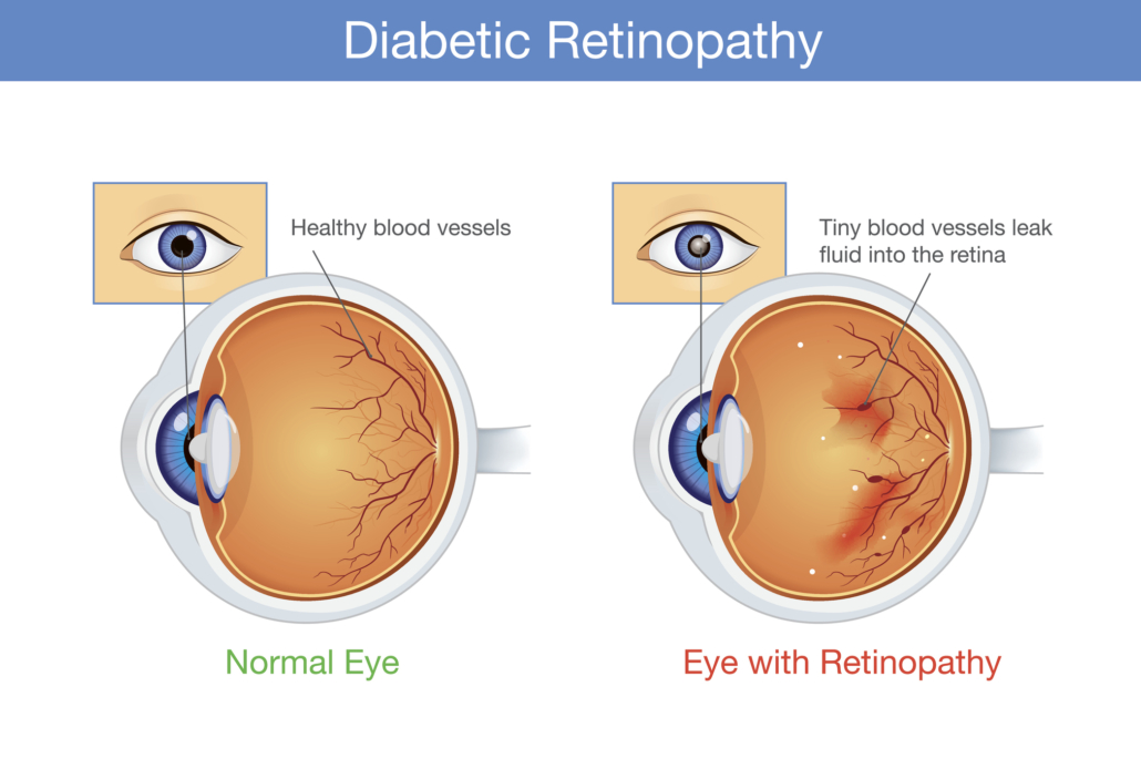case presentation of diabetic retinopathy