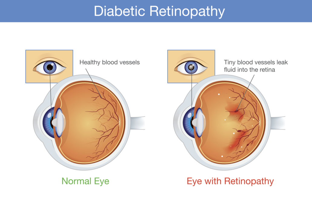 Diabetic Retinopathy Treatment Symptoms And Causes Mohan Eye Institute