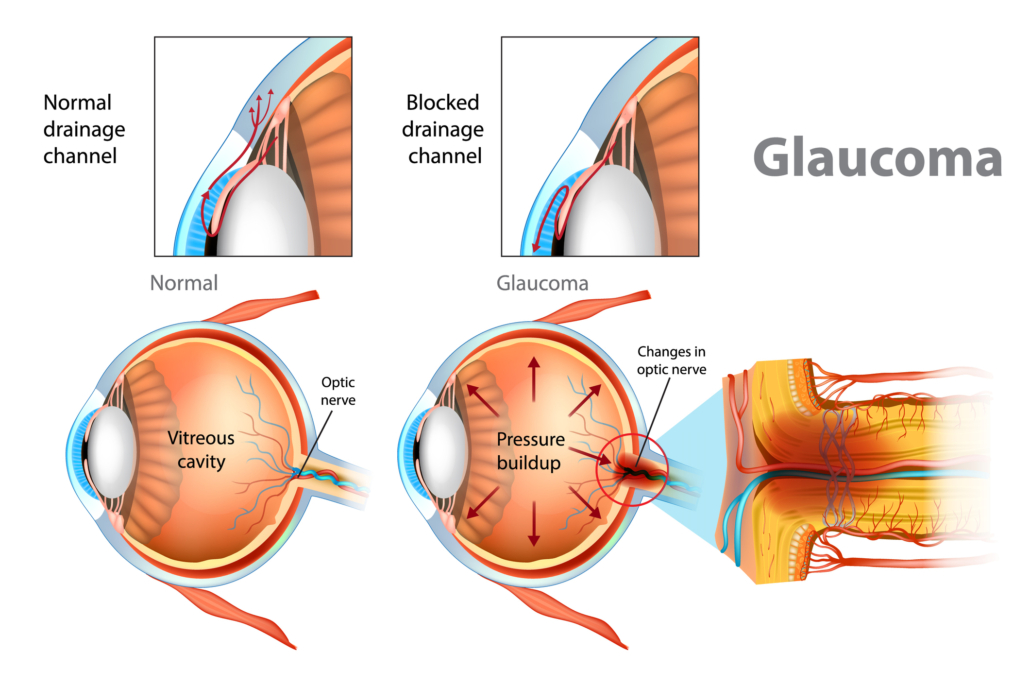 Glaucoma iStock