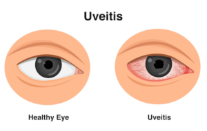 Uveitis Specialist In Delhi | Uveitis Hospital in Delhi - Mohan Eye ...